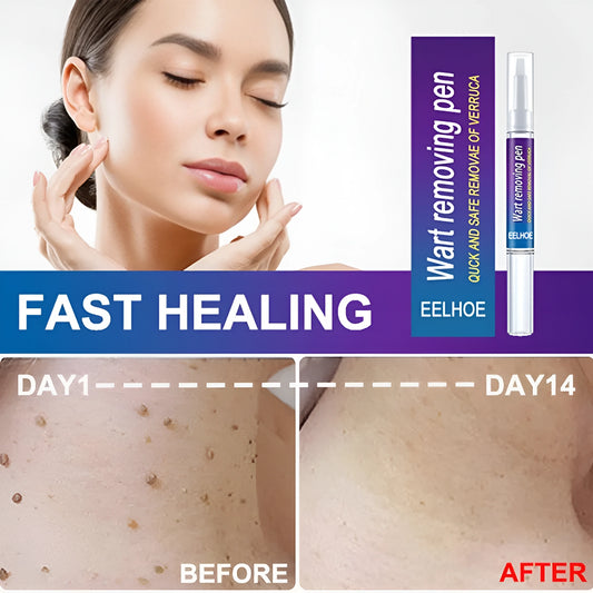 Quick Wart/Mole Removal Pen