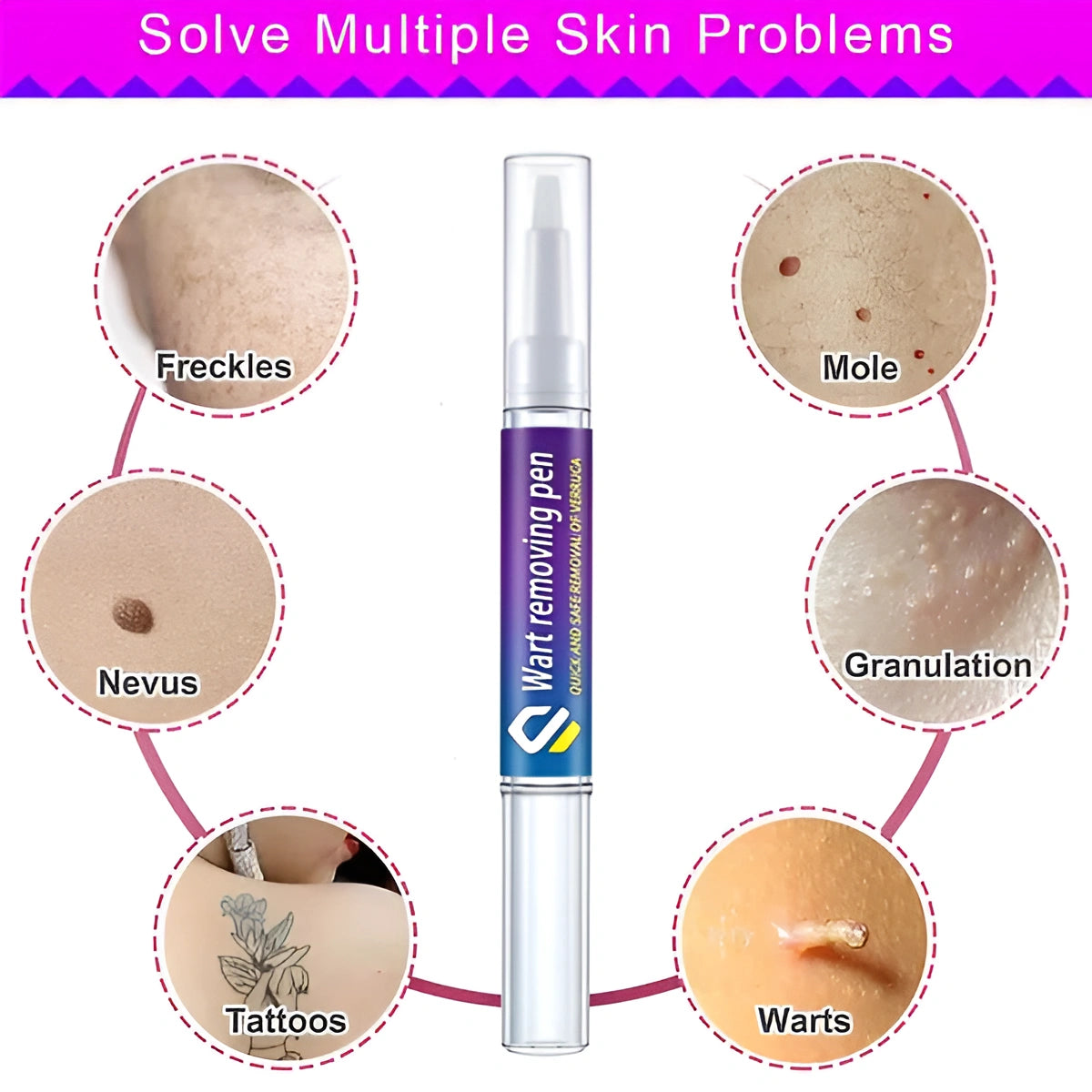 Quick Wart/Mole Removal Pen