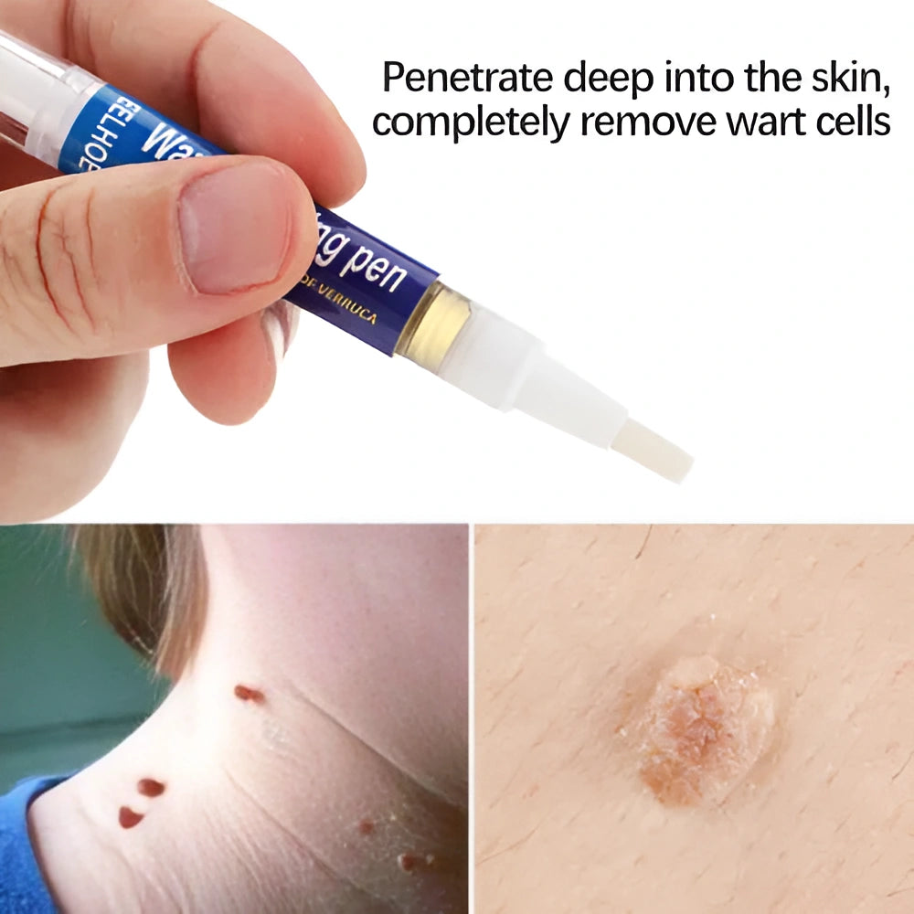 Quick Wart/Mole Removal Pen