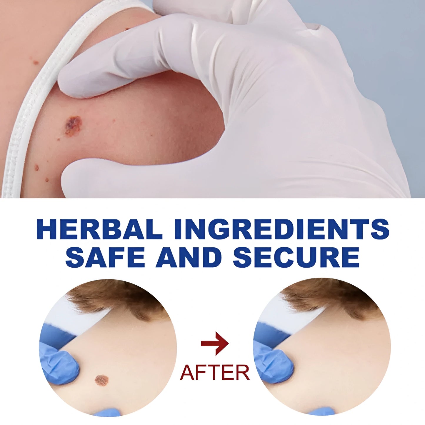 Quick Wart/Mole Removal Pen